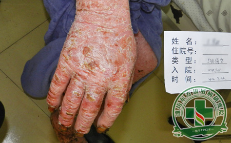 关节型银屑病