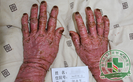 男性银屑病