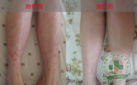 脓疱型银屑病