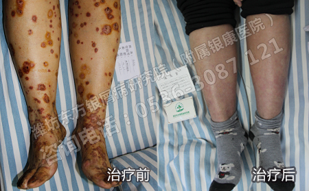 病情稳定后