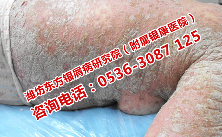 治银屑病什么方法理想