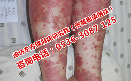 潍坊脓疱型牛皮癣应该去哪儿治疗