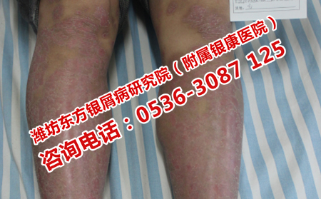 如何防治红皮型银屑病