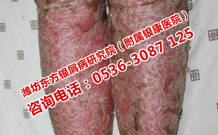 银屑病的专业护理