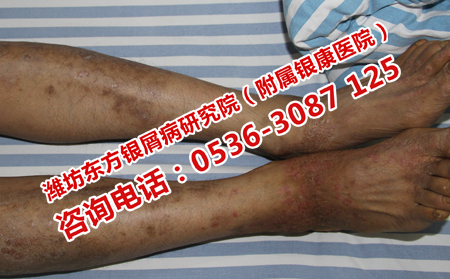 牛皮癣患者在日常应该注意什么