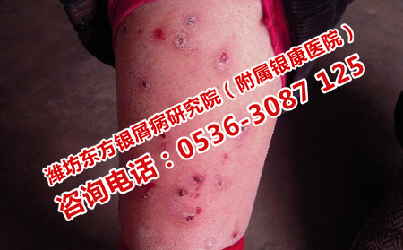 哪家医院治疗牛皮癣理想