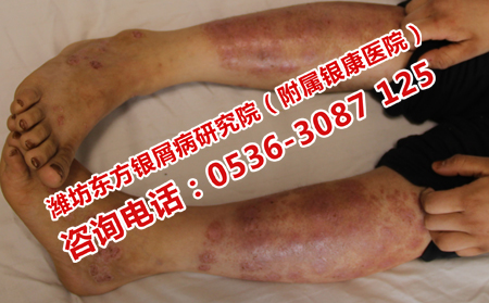 治疗牛皮癣理想的医院