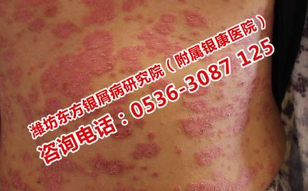 潍坊哪家医院治疗牛皮癣效果专业