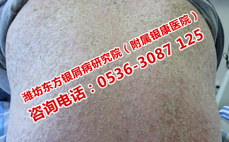牛皮癣正确的治疗方法是什么