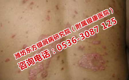 男性银屑病怎么治疗理想的快