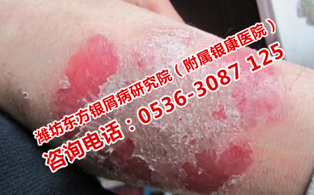 哪里治理想银屑病
