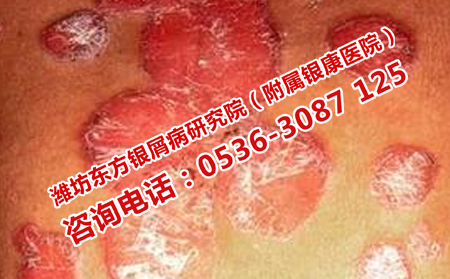 治疗牛皮癣什么方法有效