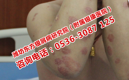 寻常型牛皮癣治不理想的原因