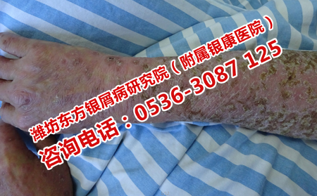 牛皮癣患者怎样吃