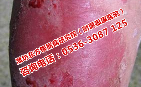 牛皮癣怎么护理理想