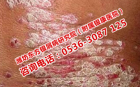 牛皮癣的预防方法有哪些