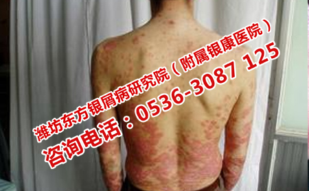 治疗牛皮癣的措施