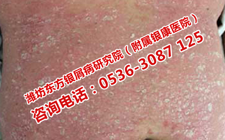 潍坊治疗牛皮癣的医院