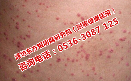 治疗牛皮癣实力强的医院