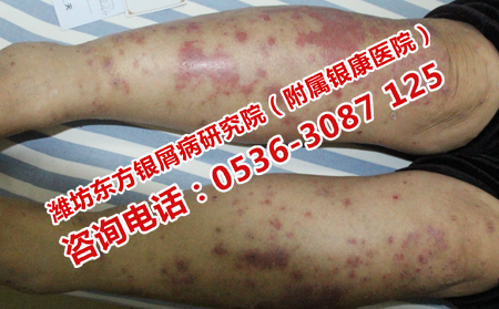 银屑病到底能治理想吗