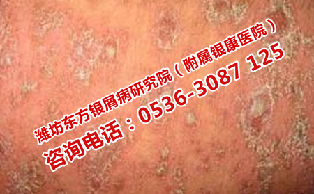 潍坊地区治疗牛皮癣