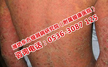 治疗男性牛皮癣
