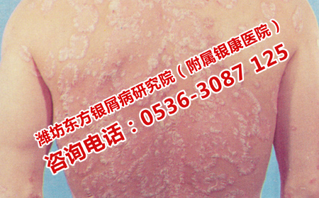 怎样辩证治疗牛皮癣