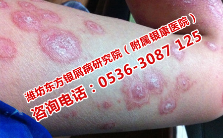 孩子牛皮癣治疗