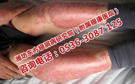 牛皮癣为什么要及早治疗