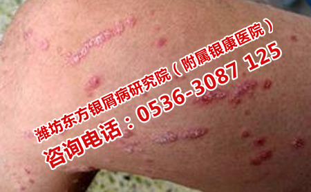 什么方法阻止牛皮癣复发