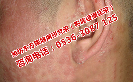 治疗牛皮癣医院理想不理想