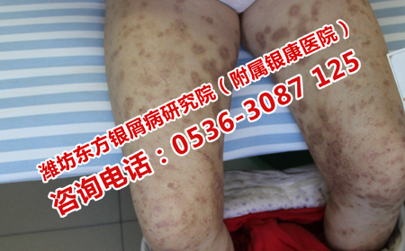 中医治疗牛皮癣抗复发吗