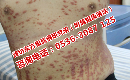 哪个医院治疗牛皮癣有效果