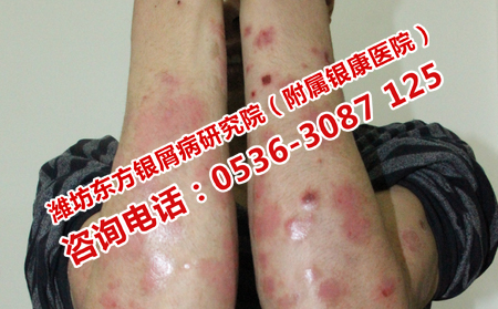 如何治疗复发性牛皮癣