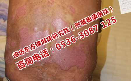 牛皮癣症状加重了怎么办