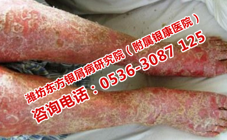 哪里治疗牛皮癣效果有效