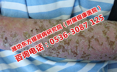 得了牛皮癣有什么危害