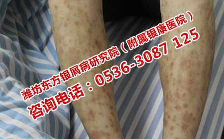 牛皮癣恢复受阻的原因