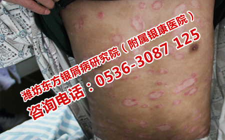 银屑病对老人的危害有哪些