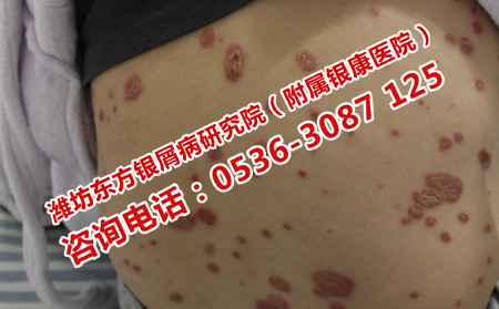 潍坊理想的银屑病治疗医院