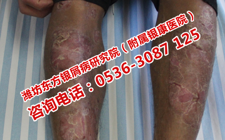 牛皮癣患者日常应该注意什么问题