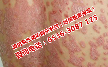 如何对牛皮癣进行长久护理