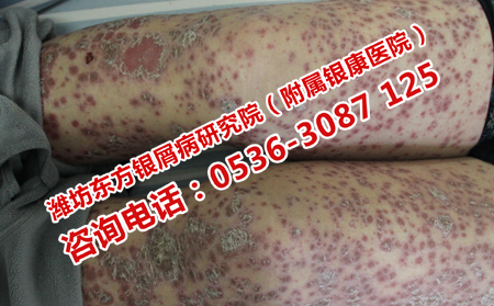 青少年牛皮癣患者吃点什么比较理想