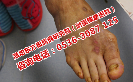 牛皮癣患者的哪些食物不能吃