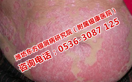 远离牛皮癣的方法会什么