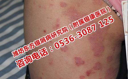 怎么治疗牛皮癣效果理想
