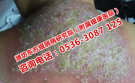 得了银屑病该如何治疗