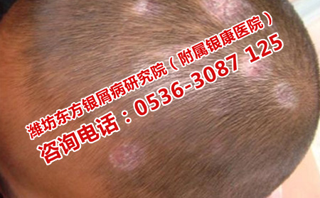 银屑病的暗斑症状是怎么回事