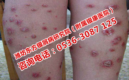潍坊哪里治疗早期牛皮癣