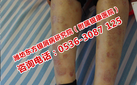 孕妇为什么会得牛皮癣